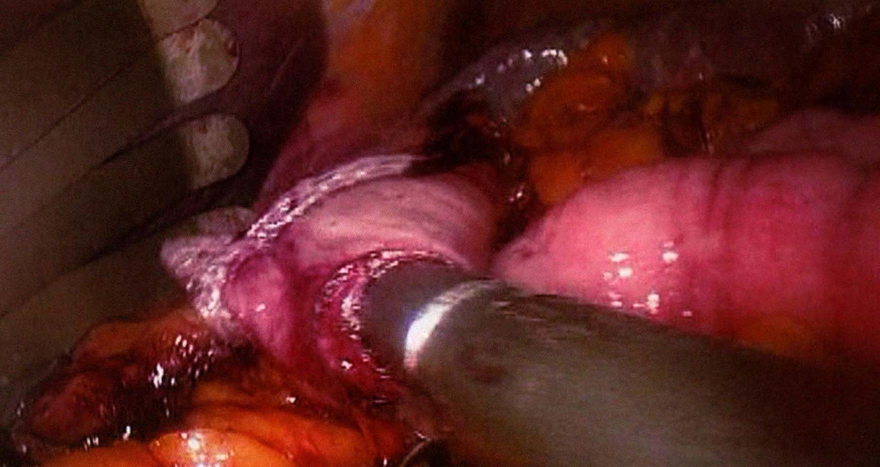 四、腹腔鏡胃次全切除術(shù)